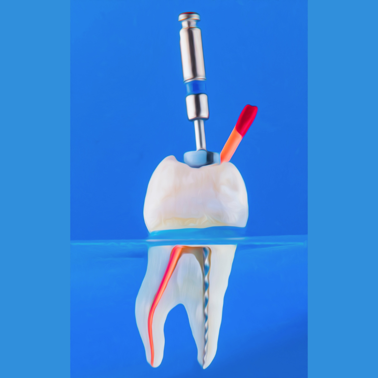 Wurzelbehandlung Zahnarzt Regensburg